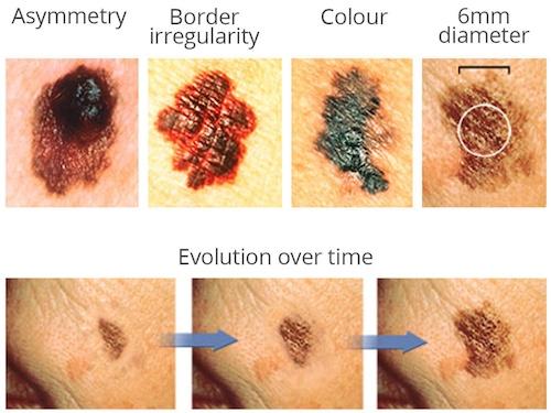 Визуализация признаков меланомы